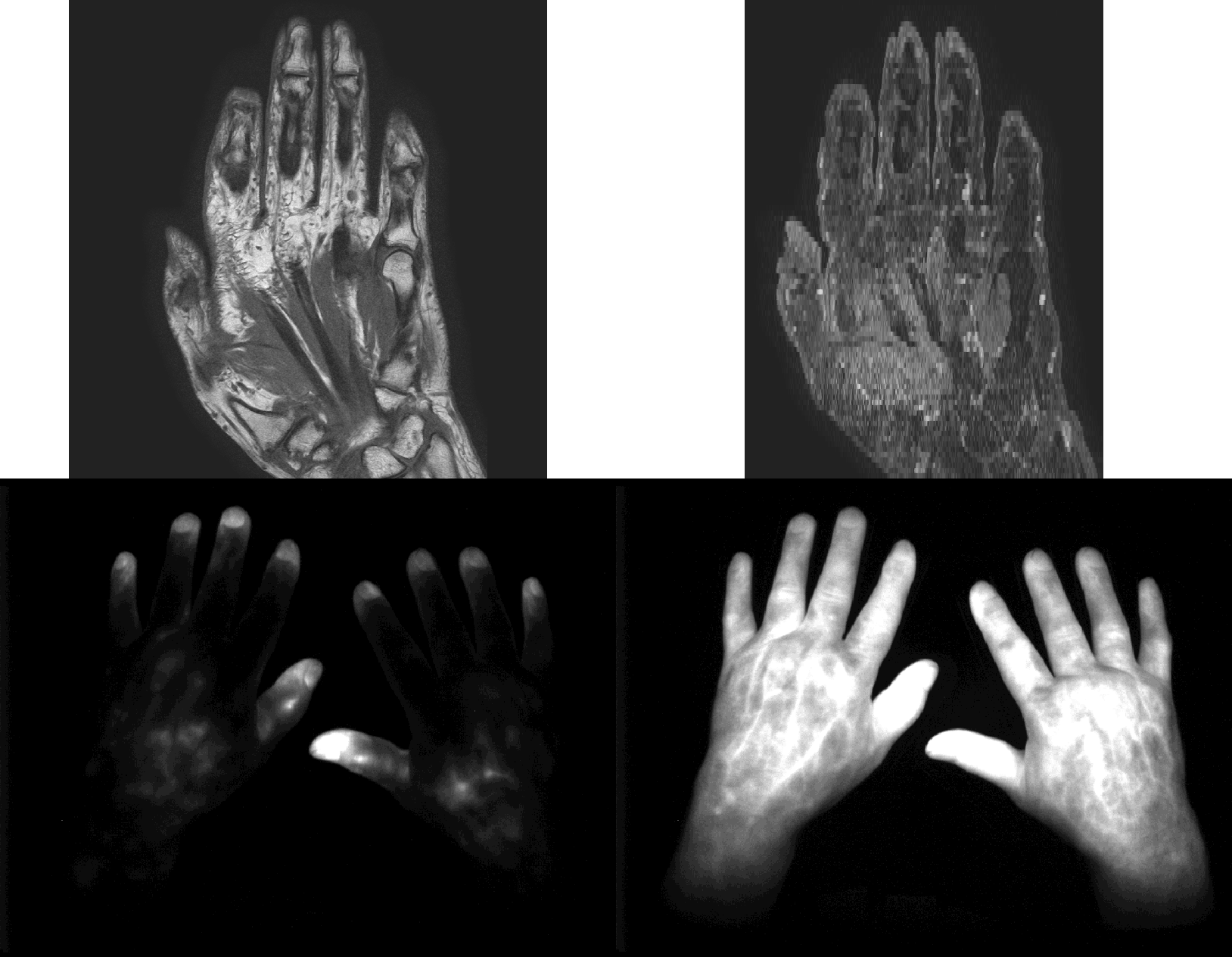 Bilddaten die bei der Diagnose einer Psoriasis Arthritis zum Einsatz kommen können: T1-gewichtetes MRI (oben links), fettgesättigtes MRI (oben rechts) und Fluoreszenz-optische Bildserien (unten ; links: früher Zeitpunkt während der Anflutund des Fluoreszenz-Mittels, rechts: später Zeitpunkt während der Anflutund des Fluoreszenz-Mittels)