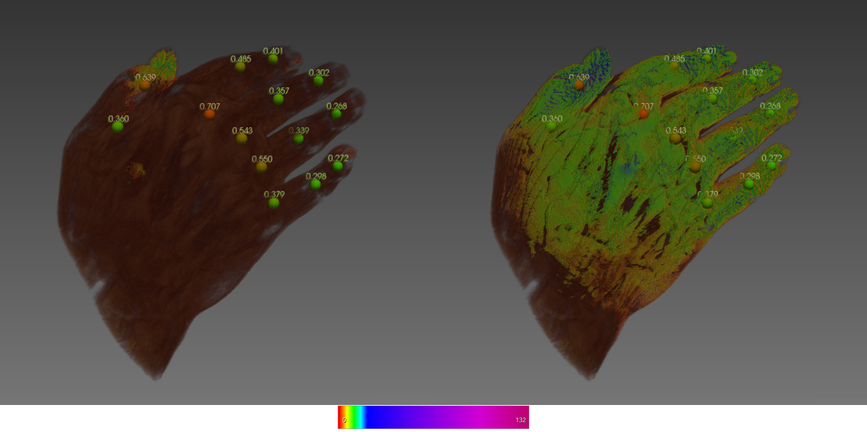 Beispielhafte Visualisierung der Areal-Scores, die aus der Auswertung der Fluoreszenz-optischen Bildgebung resultieren in Kombination mit der Volumenregistrierten Fluoreszenz-optischen Bildserie und des zugehörigen MRT der Hand. Das linke Bild ist im frühen Stadium der Fluoreszenz-Mittel-Anflutung, das rechte Bild zu einem späteren Zeitpunkt enstanden.